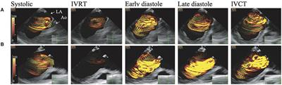 Preoperative Left Ventricular Energy Loss in the Operating Theater Reflects Subjective Symptoms in Chronic Aortic Regurgitation